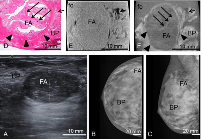 Fibroadenoma Concise Medical Knowledge