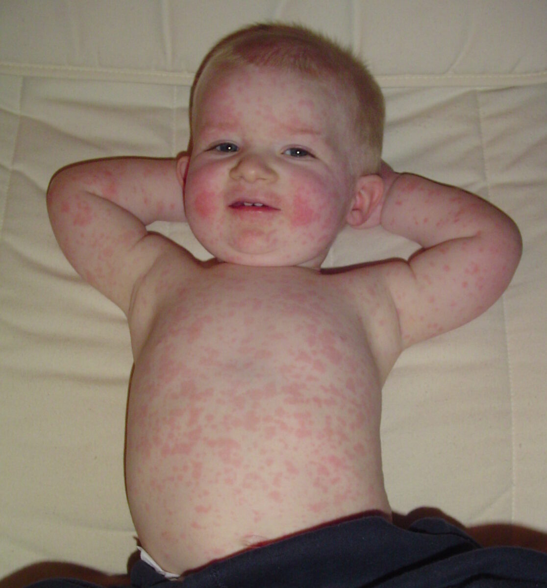 Pediatric patient with fifth disease