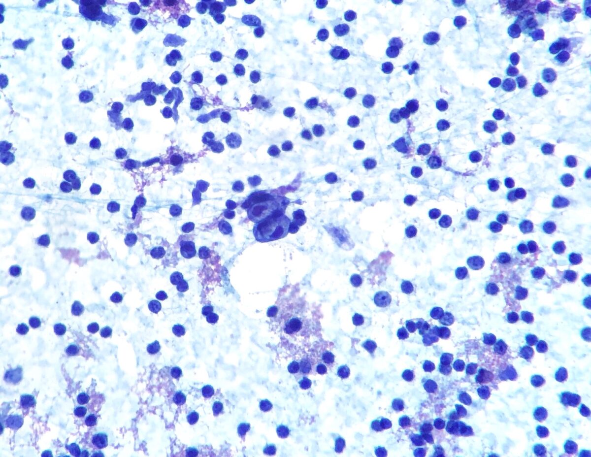 Fine-needle aspiration of hodgkin lymphoma