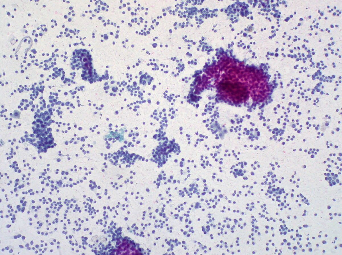Fine-needle aspiration of the liver showing metastatic carcinoid
