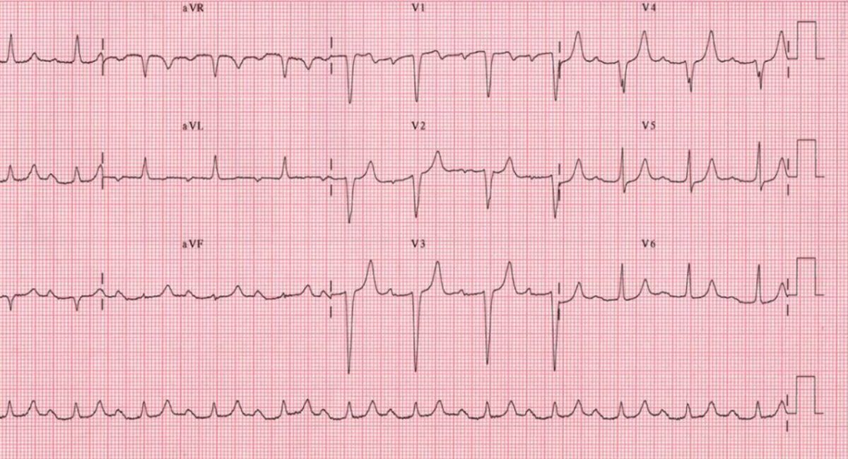 First-degree av block ecg