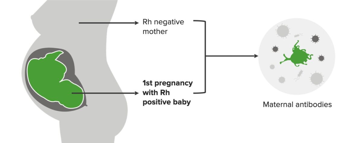 First pregnancy with rhesus incompatibility