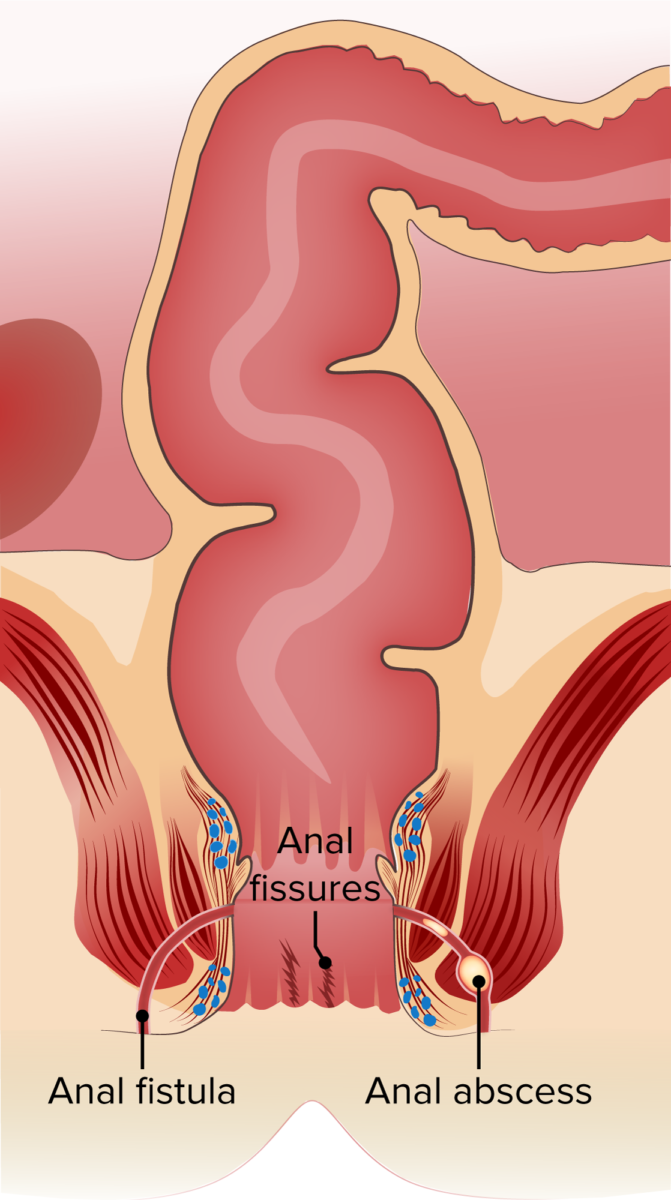 Fistula, fissures and abscess