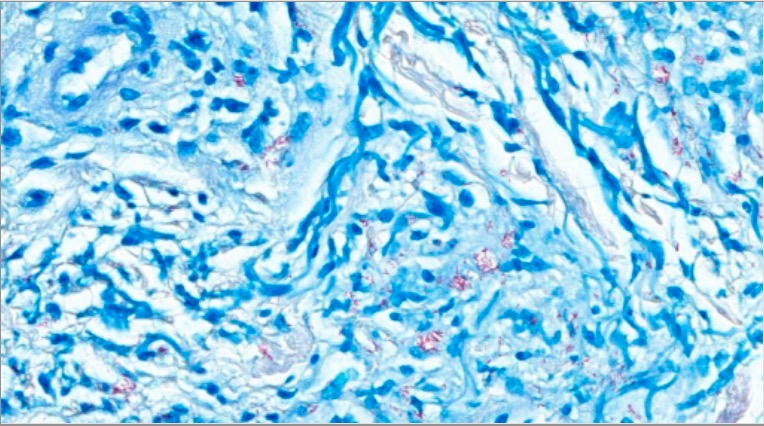 Fite stain positive for mycobacterium spp