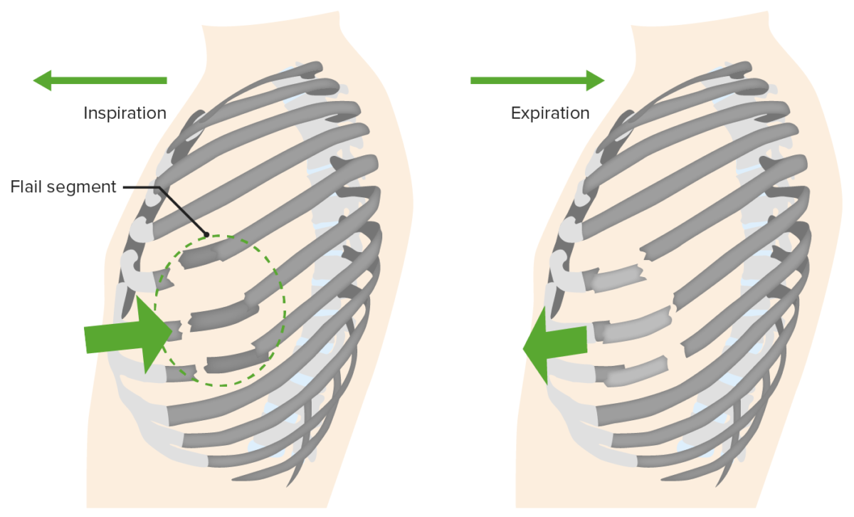 Flail chest