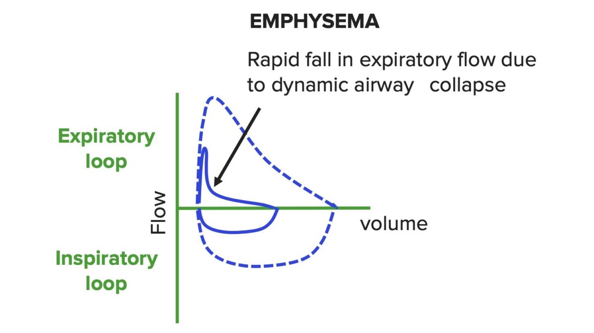 Curva de flujo-volumen en enfermedad pulmonar obstructiva enfisema