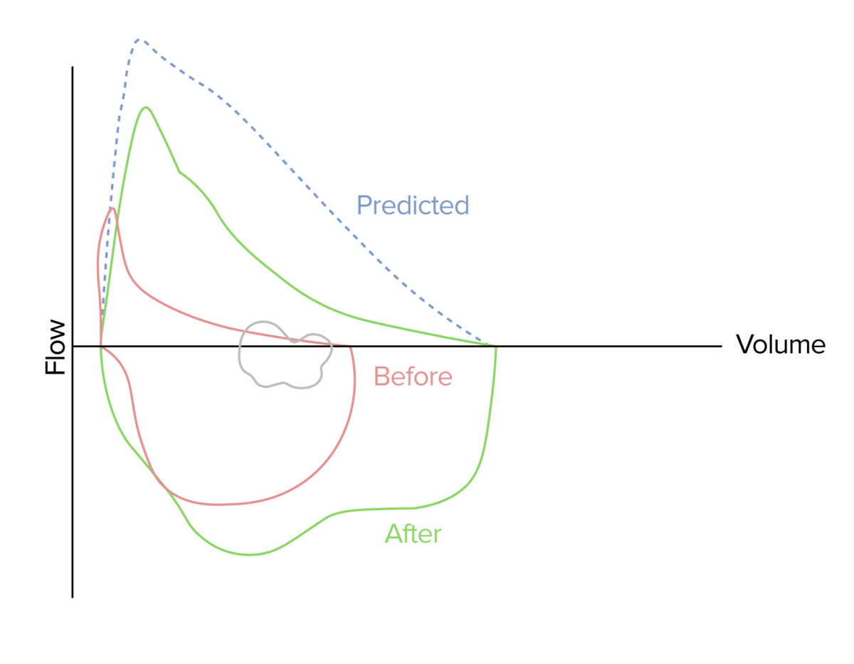 Flow volume loop