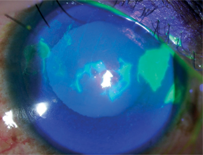 Fluorescein staining corneal abrasion epithelial defects