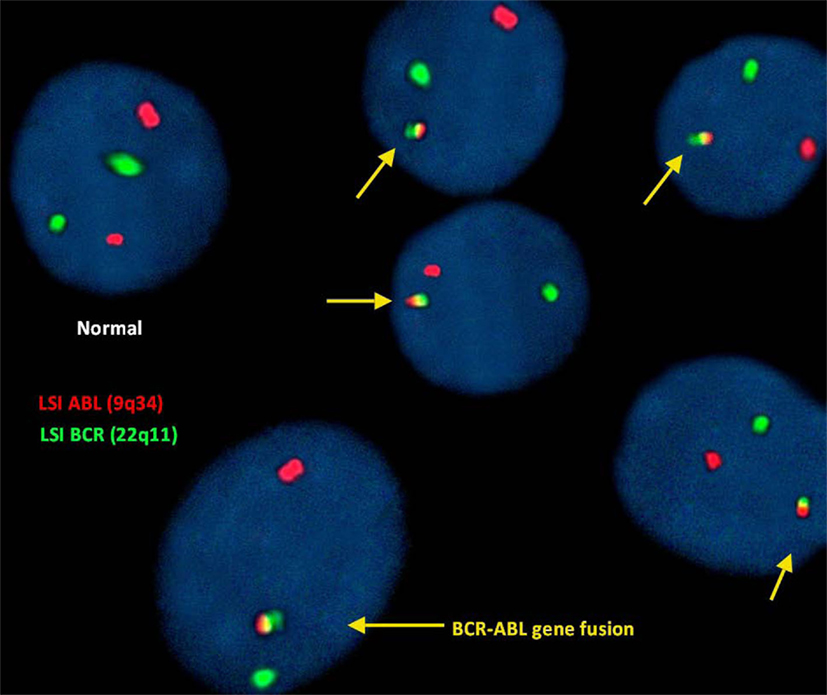 Fluorescence in situ hybridization for chronic myeloid leukemia