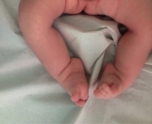 Foot deformity in a newborn