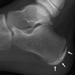 Foot pain - Sclerosis and fragmentation of the calcaneal apophysis
