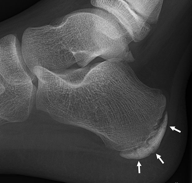 Foot pain - sclerosis and fragmentation of the calcaneal apophysis