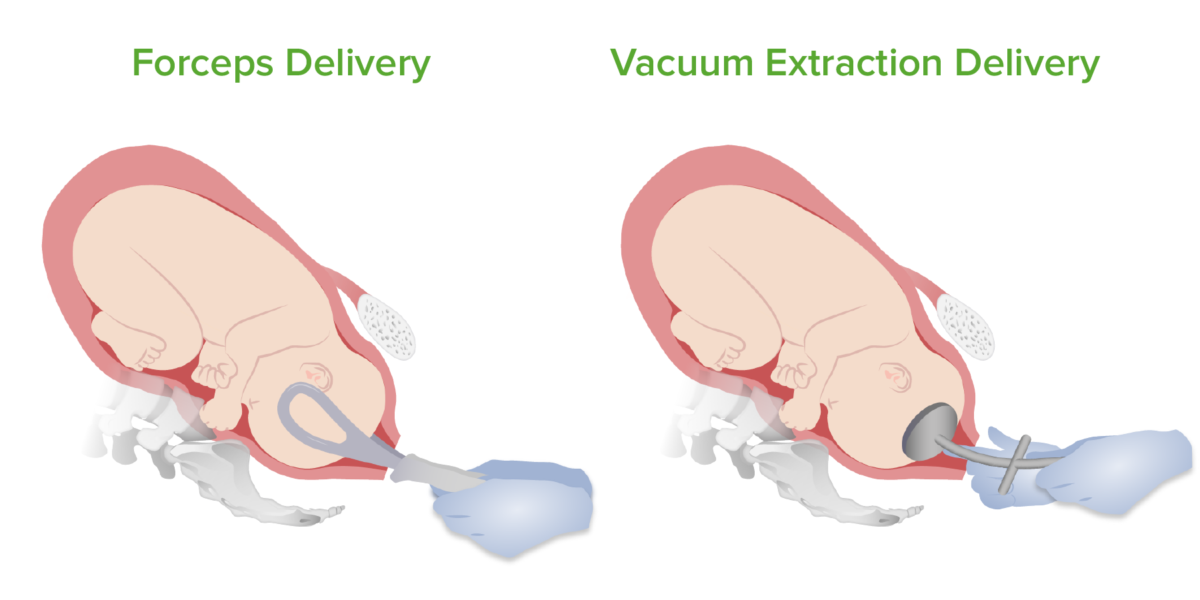 Forceps and vacuum deliveries