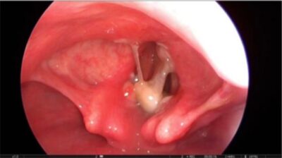 Foreign body stuck between vocal cords