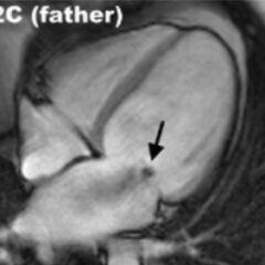 Four-chamber view cine-MRI showing dilated cardiomyopathy