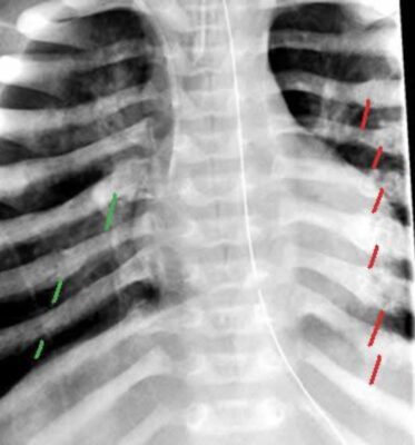 Fractures of ribs in an infant