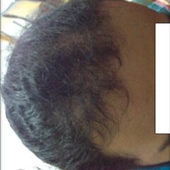 Frontal alopecia due to Acanthosis Nigricans