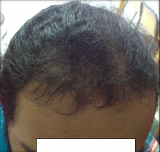 Frontal alopecia due to acanthosis nigricans