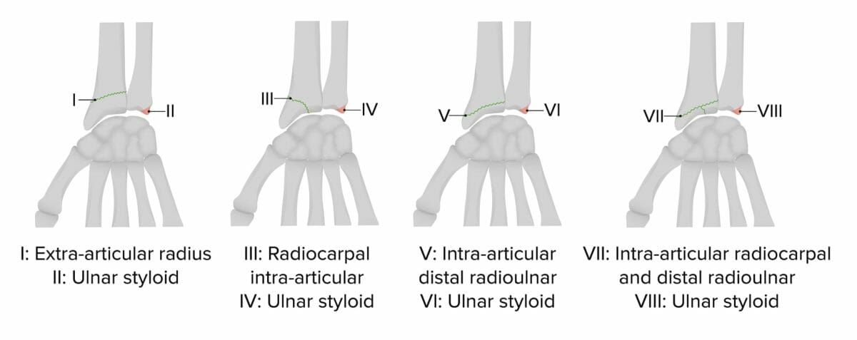 Frykman classification of distal radius fractures