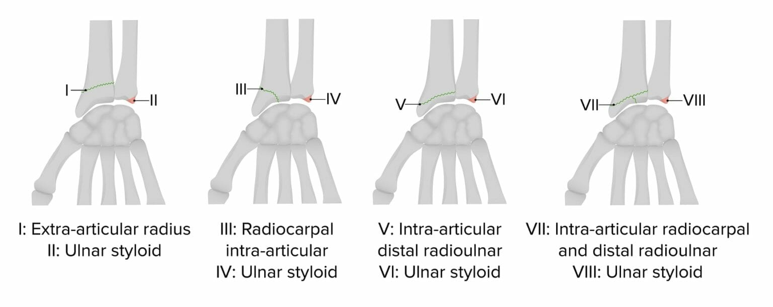 Distal Radius Fractures Concise Medical Knowledge