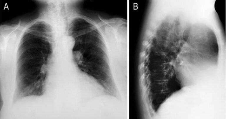 Mediastinite | Concise Medical Knowledge