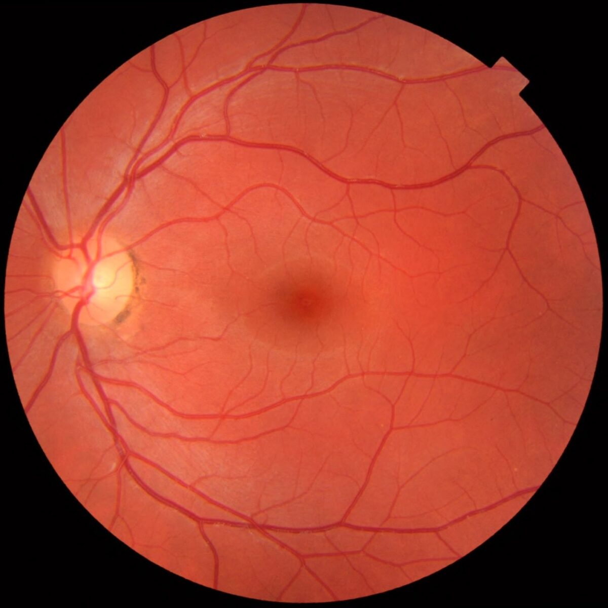 Fundus of the eye as seen through an ophthalmoscope