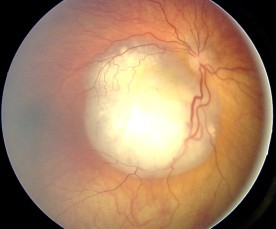 Fundus retinoblastoma