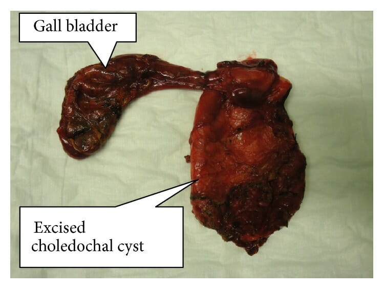 Resected specimen of completely excised choledochal cyst with gall bladder