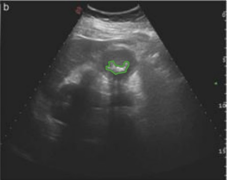 Gallstone ultrasound