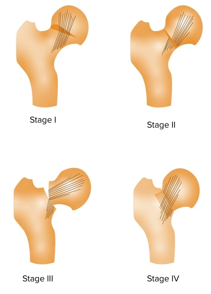 Garden classification of femoral neck fractures