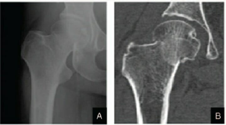 Garden stage i right femoral neck fracture