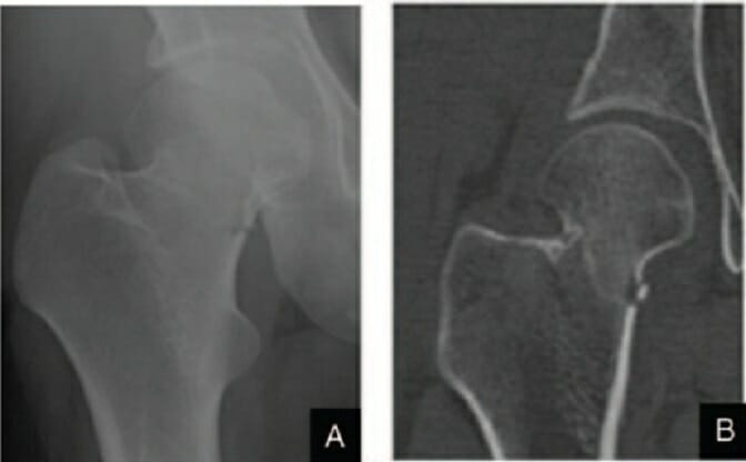 Garden stage ii right femoral neck fracture