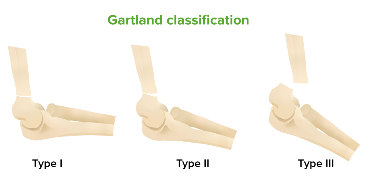 grading supracondylar fracture