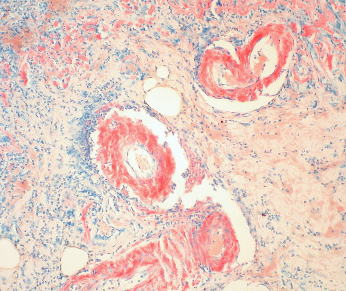 Gastric amyloidosis with h&e staining