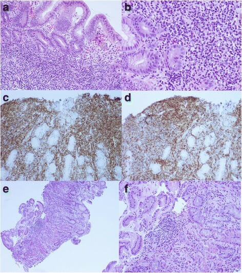 Gastric mucosa-associated lymphoid tissue lymphoma and helicobacter pylori infection