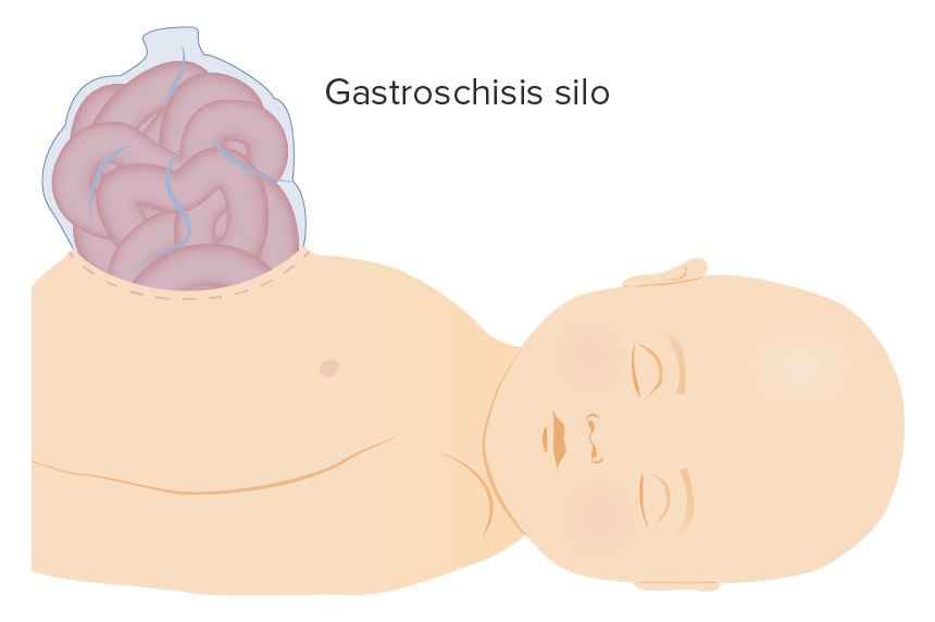Gastroschisis silo illustration