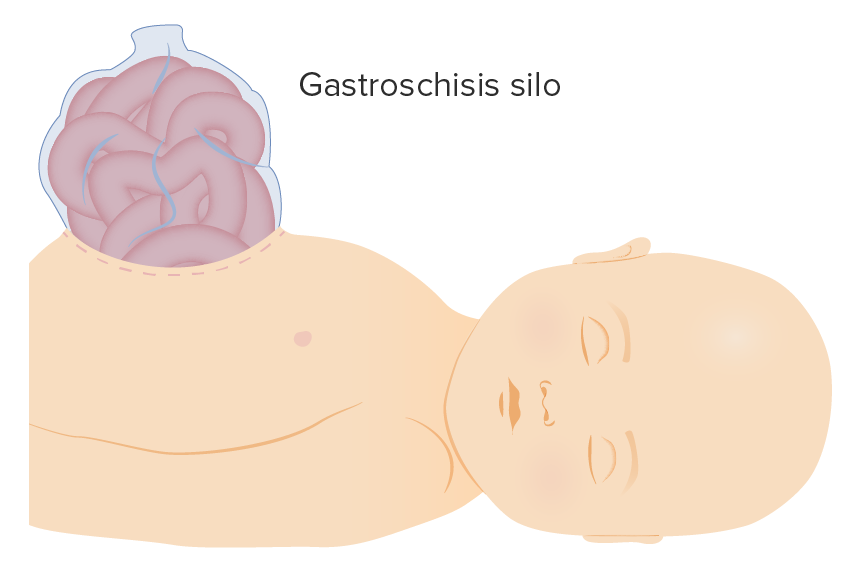 Ilustración del silo de gastrosquisis