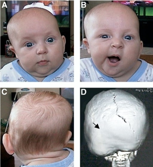 Genetics of craniosynostosis