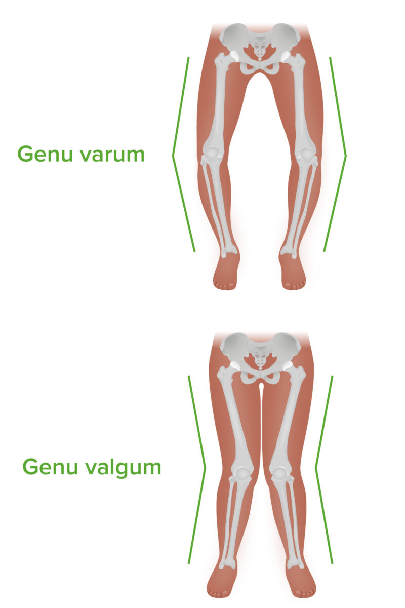 Genu varum and valgum