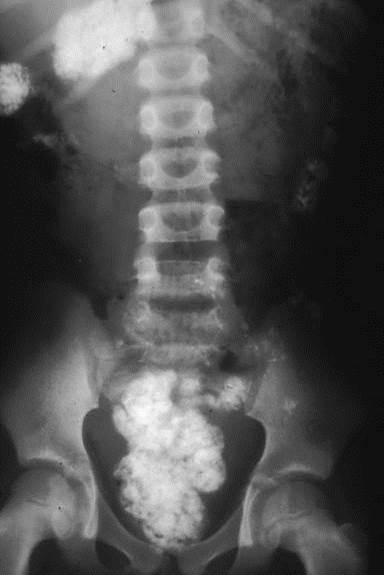 pica eating disorder x rays