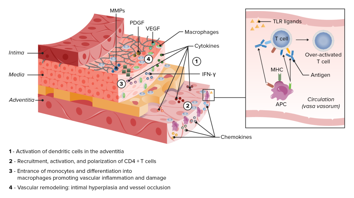 Pathophysiology in giant cell arteritis