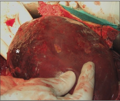Giant hepatic hemangioma
