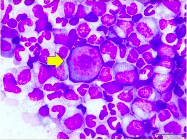 Giant pronormoblast in the bone marrow