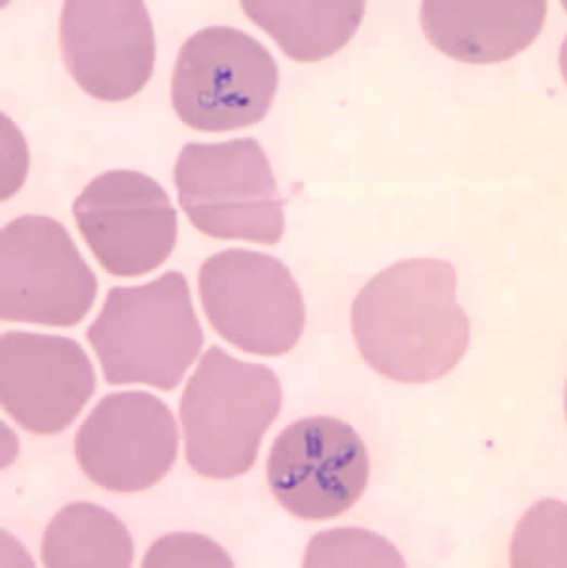 Giemsa stain of babesia infection
