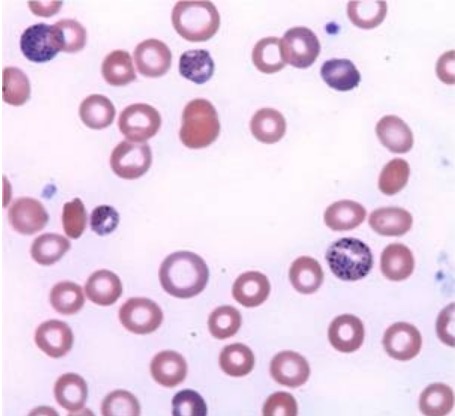 Giemsa stain of coarse basophilic stippling or erythrocytes due to lead poisoning