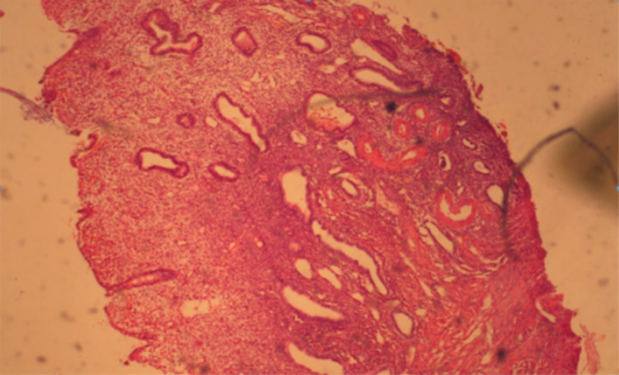 Glandular cystic endometrial polyp