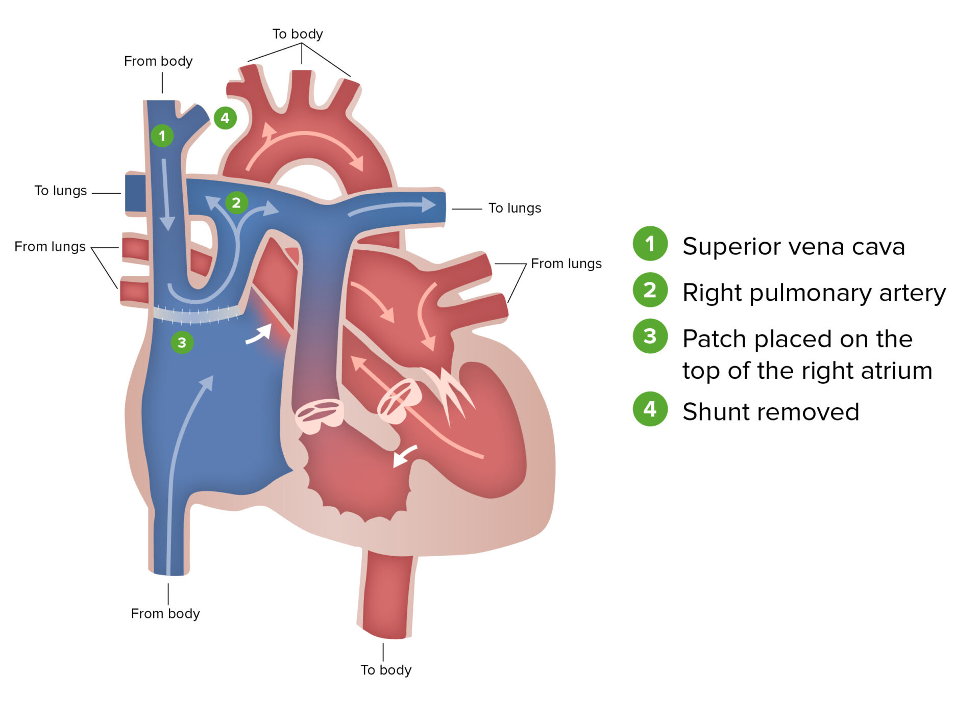 Hypoplastic Left Heart Syndrome (HLHS) | Concise Medical Knowledge