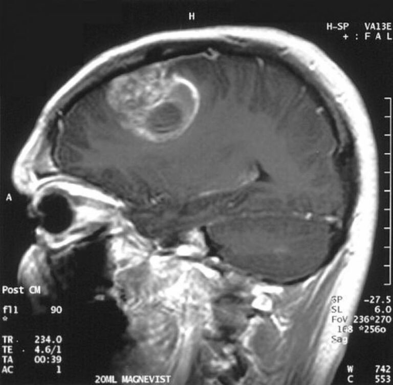 Glioblastoma Multiforme | Concise Medical Knowledge