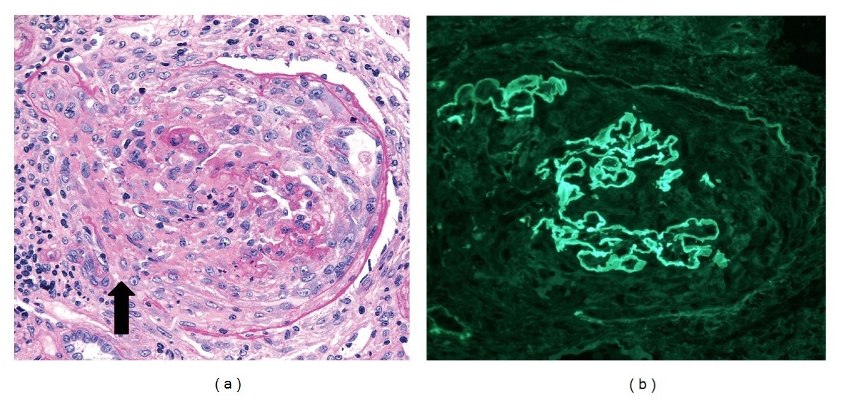 Glomeruli from a kidney biopsy of a patient with crescentic gn
