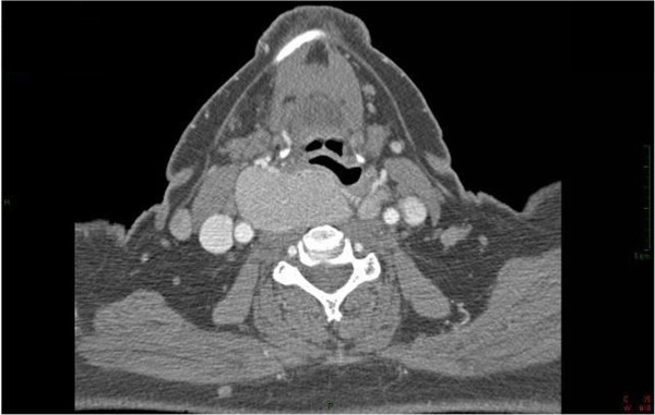Goiter with obstructive effect ct
